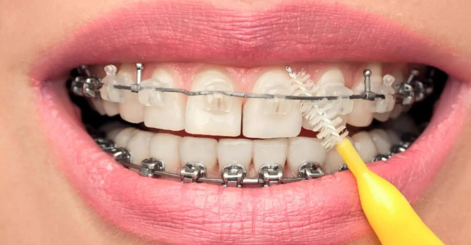 do orthodontics clean teeth 2